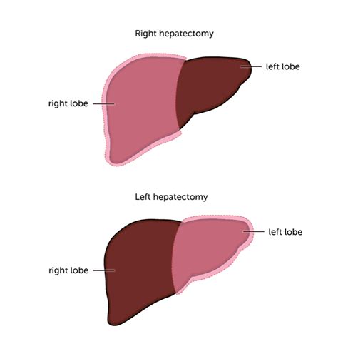 Types Of Surgery Liver Cancer Uk