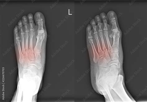 X Ray Foot Ap Oblique Fracture Proximal Metaphysis Of The Nd Rd And Th Metatarsal Bones