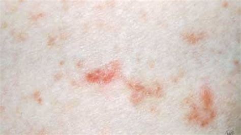 What You Need To Know About Scabies