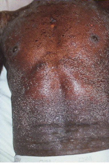 Lichenoid Erythrodermic Bullous Pemphigoid Of The African Patient