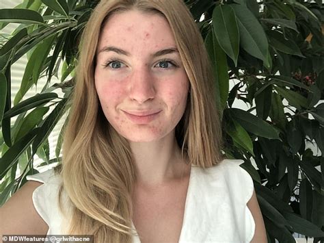 Woman Who Had Cystic Acne So Severe That It Affected Her Sight Celebrity WShow