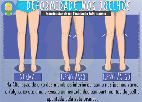 Alinhamento Valgo De Joelho