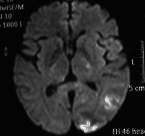 Brain Mri Dwi Left Occipital Cortical Restriction In Dwi Download