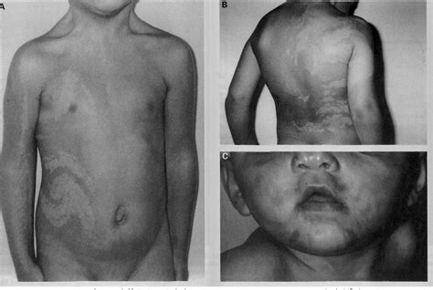Figure 1 From Hypomelanosis Of Ito Clinical Syndrome Or Just Phenotype