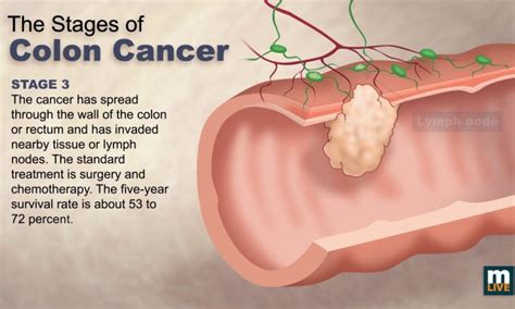 Stage 4 Colon Cancer What You Need To Know Tech News Era