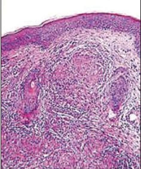 Histopathology Of Lupus Vulgaris Showing Noncaseasting Open I