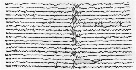 Benign rolandic epilepsy accounts for about 15% of the cases of epilepsy in children. Clinical and EEG characteristics of benign rolandic ...