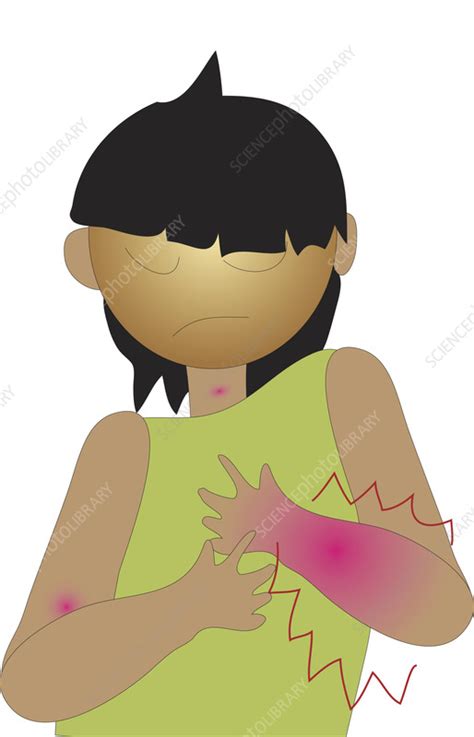 Painful Skin Disorder Illustration Stock Image F0375992 Science