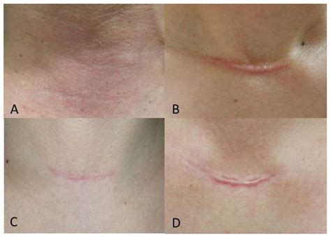 Scar Tissue After Thyroid Surgery