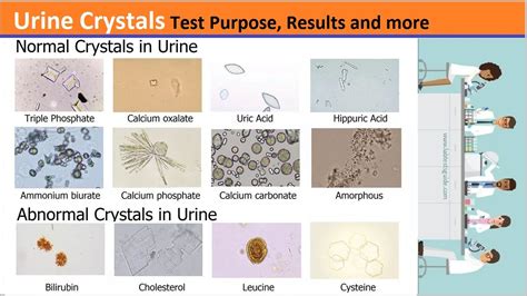 Crystals In Urine Ltg