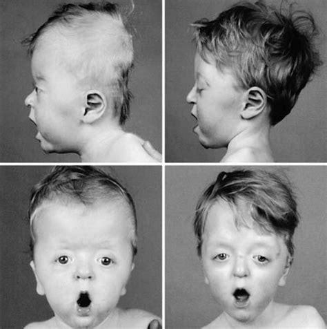 Dynamic Cranioplasty For Brachycephaly In Apert Syndrome Long Term