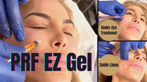 Prf Ez Gel Plasma Under Eye And Smile Line Treatment Prf Youtube