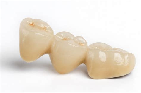 Porcelain Fused To Metal Pfm Dental Crowns And Bridges Semdent