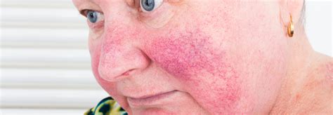 Wie Behandeln Sie Die Chronische Rosacea Ihre Meinung Ihre