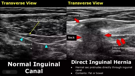 Indirect Vs Direct Inguinal Hernia