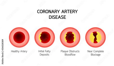 Coronary Artery Disease Infographic Heart Awareness Concept