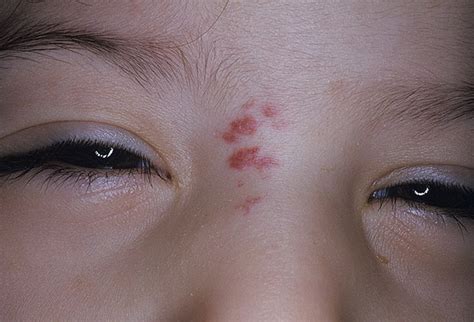 infant hemangioma pictures 54 photos and images