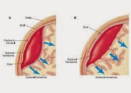 Vulva Hematoma Images 17220 The Best Porn Website