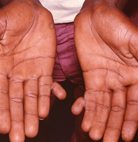 Polydactyly Symptoms Causes And Treatments