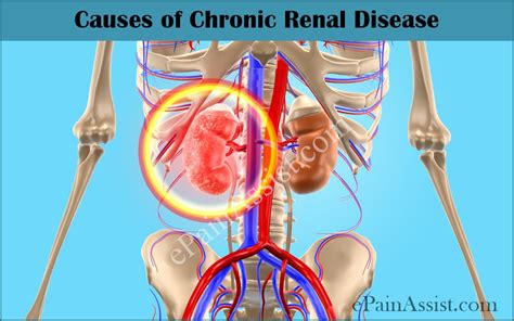 Chronic kidney disease, also called chronic kidney failure treatment for chronic kidney disease focuses on slowing the progression of the kidney damage, usually by controlling the underlying cause. Chronic Renal Disease|Pathophysiology|Causes|Stages ...