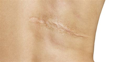 Tratamiento De Las Cicatrices Hipertróficas Y De Los Queloides Con