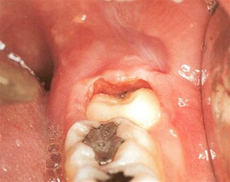 Pericoronitis Pictures Treatment Symptoms Causes 2018 Updated