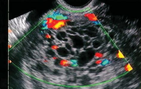 Transvaginal Ultrasound In A Patient With Bleeding At 14 Weeks Of