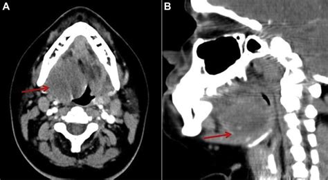 E Contrast Enhanced Axial A And Sagittal Reformatted B Ct Images Of