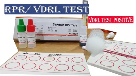 Vdrl Test Syphilis Testrpr Test Procedure Youtube