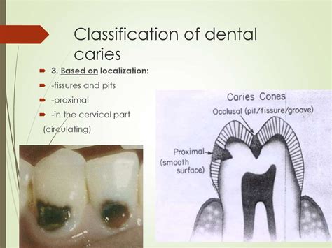 Dental Caries Classification
