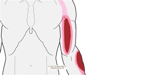 Trigger Points Pain Along The Collar Bone And Down The Arm