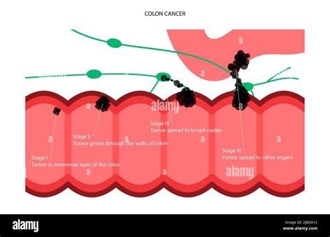 Estadios del cáncer de colon ilustración Fotografía de stock Alamy