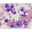 Plasma Cell Myeloma  CELL Atlas Of Haematological Cytology
