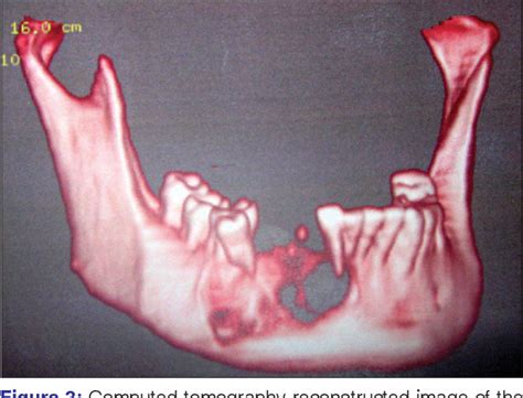 Figure 3 From Pindborg Tumor Semantic Scholar