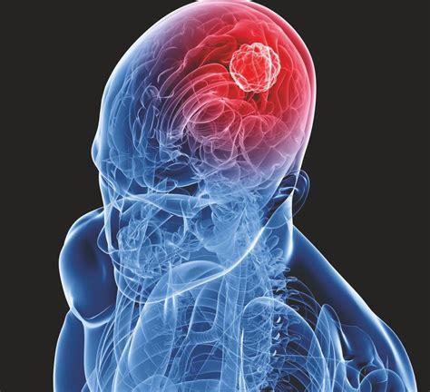 Risk Factors And Warning Signs For Brain Tumors