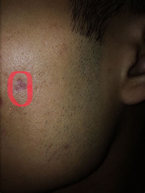 Urgent Help Had A Huge Cyst Or Nodule Worried About Scarring