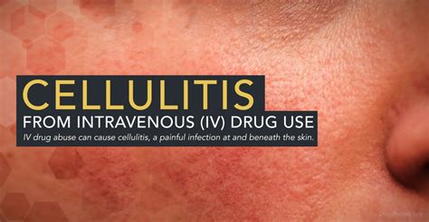 Cellulitis From Intravenous Iv Drug Use