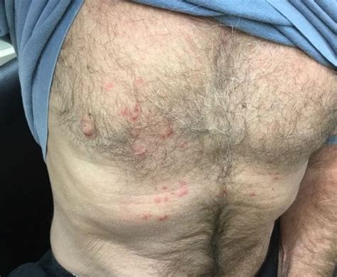 Clinical Challenge Rash On Chest And Extremities Mpr