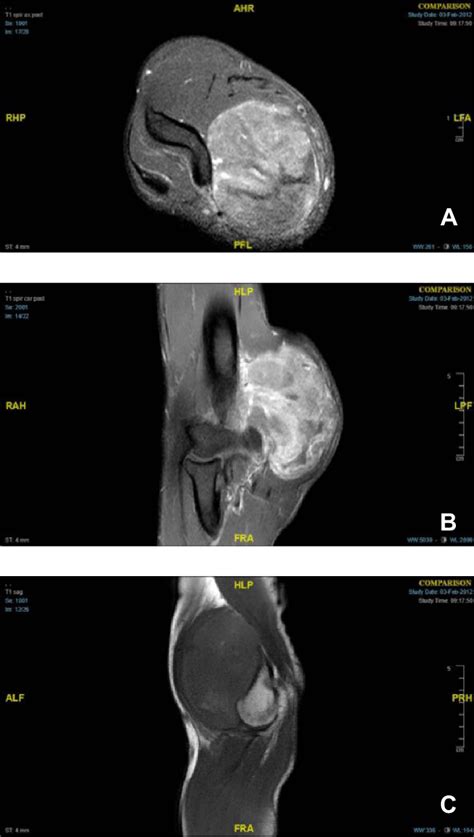 Right Elbow Mri Series Showing A Large Heterogeneously Enhancing And