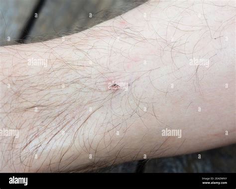 A Man Has A Deer Or Black Legged Tick Bite Ixodes Scapularis Bite On