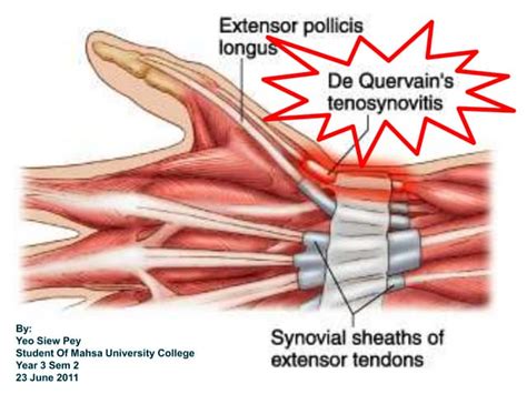 De Quervain Syndrome Vector Illustration Labeled Thumb Inflammation