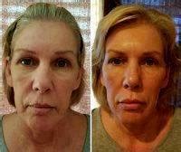 You want to make an app? How Much Does A Facelift Cost In Phoenix? » Facelift: Info ...