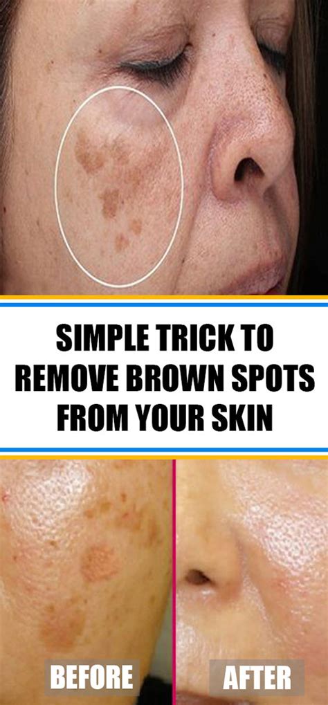 Brown Spots On Skin Causes