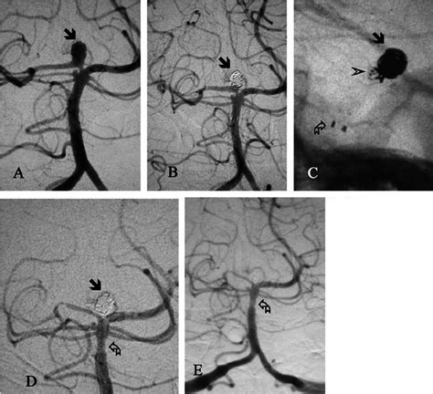 Small Broad Based Aneurysm On The P1 Section Of The Posterior Cerebral