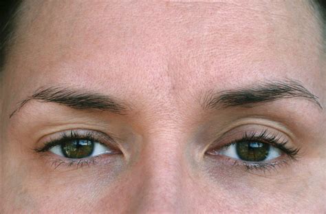 Droopy Eyelids Heres Everything You Need To Know About Ptosis Surgery