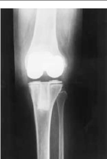 Figure 1 From Infected Total Knee Replacements Semantic Scholar