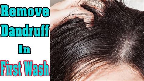 A strong alkaline paste, applied to you skin for a few minutes, dissolves the hair at the skin surface and a little way below the skin. #removedandruff | How to remove dandruff, Dandruff ...