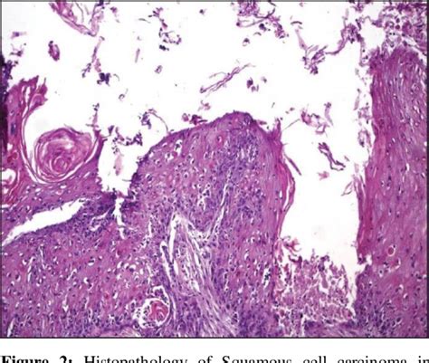 Figure 2 From Squamous Cell Carcinoma Arising In A Dermoid Cyst Of The