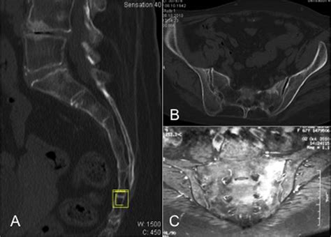 Reliability And Effectiveness Of Percutaneous Sacroplasty In Sacral