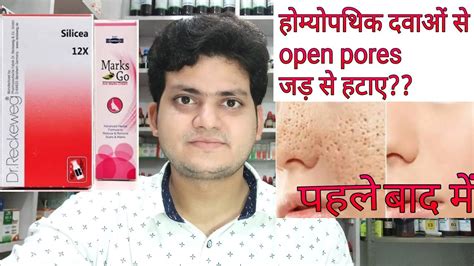 How To Remove Open Pores Of Face Permanently By